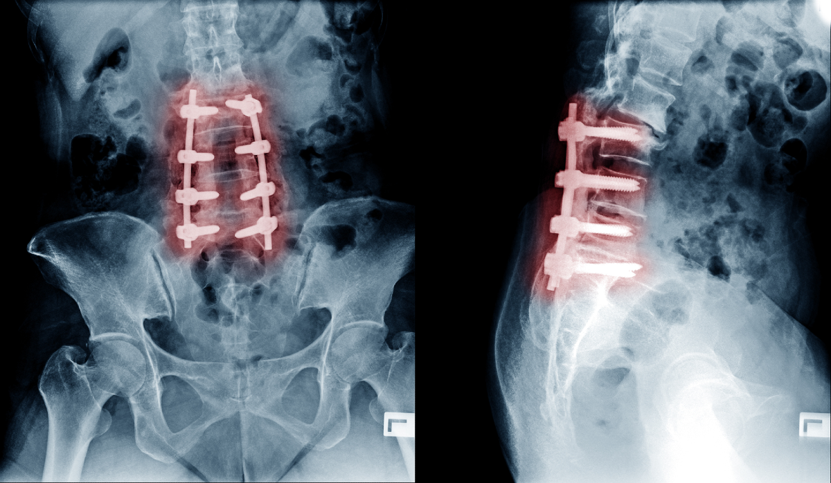 Spinal Fusion X Ray